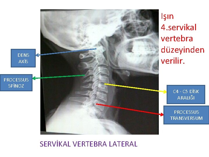 Işın 4. servikal vertebra düzeyinden verilir. DENS AXİS PROCESSUS SPİNOZ C 4 - C