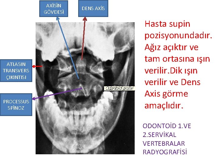 AXİSİN GÖVDESİ ATLASIN TRANSVERS ÇIKINTISI PROCESSUS SPİNOZ DENS AXİS Hasta supin pozisyonundadır. Ağız açıktır