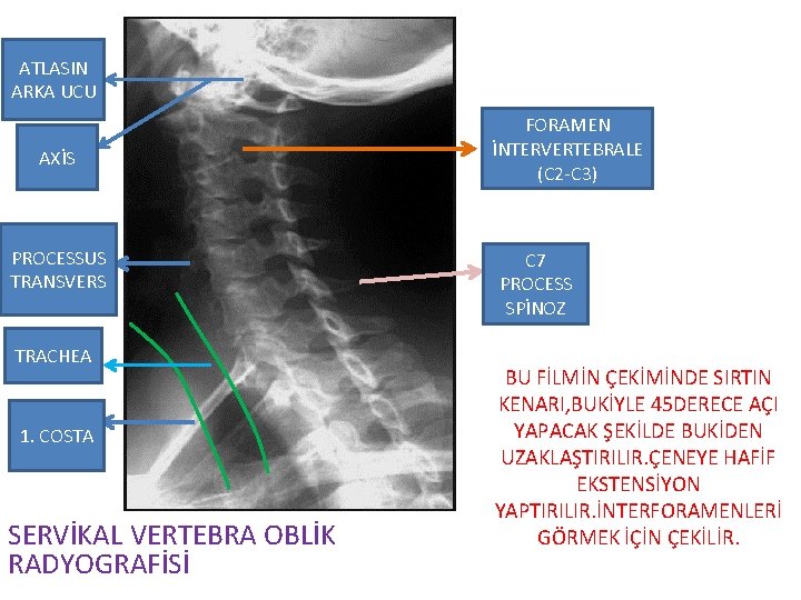 ATLASIN ARKA UCU AXİS PROCESSUS TRANSVERS TRACHEA 1. COSTA SERVİKAL VERTEBRA OBLİK RADYOGRAFİSİ FORAMEN