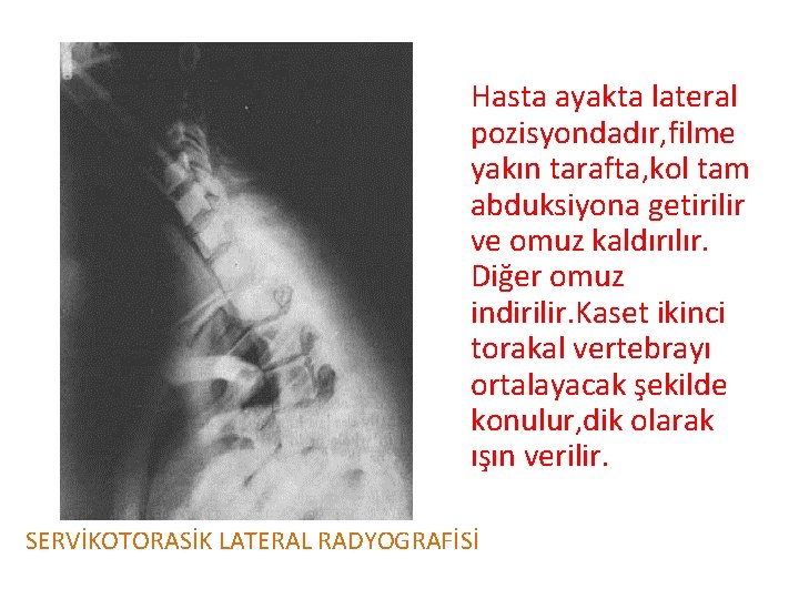 Hasta ayakta lateral pozisyondadır, filme yakın tarafta, kol tam abduksiyona getirilir ve omuz kaldırılır.
