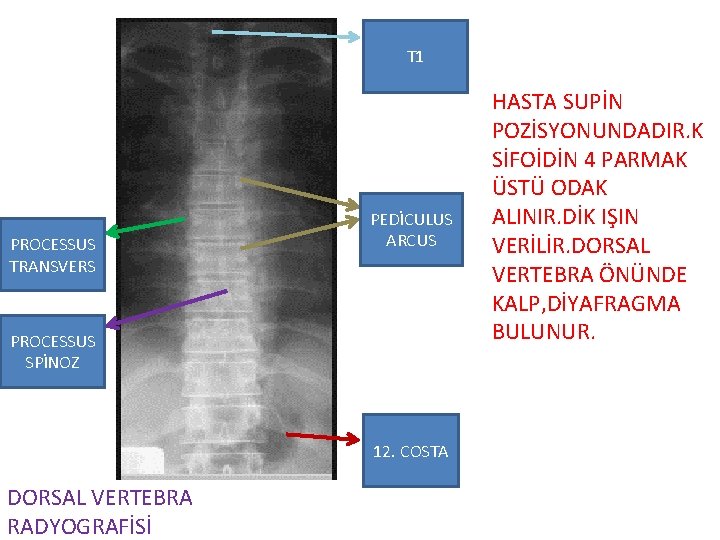 T 1 PROCESSUS TRANSVERS PEDİCULUS ARCUS PROCESSUS SPİNOZ 12. COSTA DORSAL VERTEBRA RADYOGRAFİSİ HASTA
