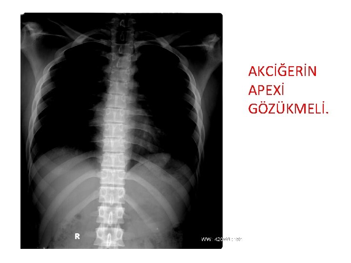 AKCİĞERİN APEXİ GÖZÜKMELİ. 