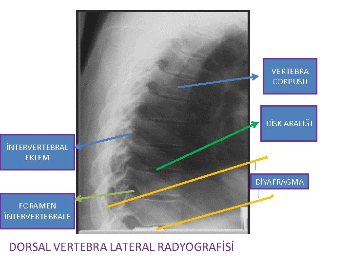 VERTEBRA CORPUSU DİSK ARALIĞI İNTERVERTEBRAL EKLEM DİYAFRAGMA FORAMEN İNTERVERTEBRALE DORSAL VERTEBRA LATERAL RADYOGRAFİSİ 