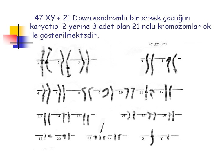 47 XY + 21 Down sendromlu bir erkek çocuğun karyotipi 2 yerine 3 adet