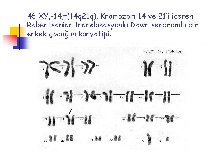 46 XY, -14, t(14 q 21 q). Kromozom 14 ve 21’i içeren Robertsonian translokasyonlu