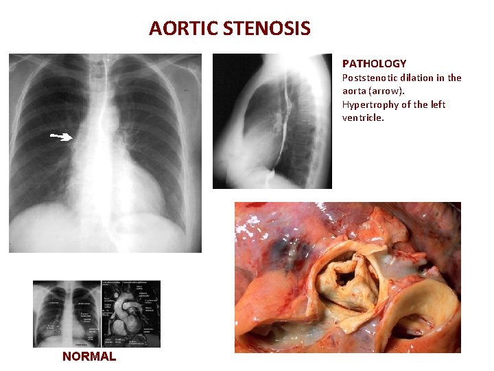 AORTIC STENOSIS PATHOLOGY Poststenotic dilation in the aorta (arrow). Hypertrophy of the left ventricle.