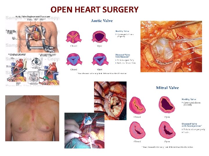 OPEN HEART SURGERY 