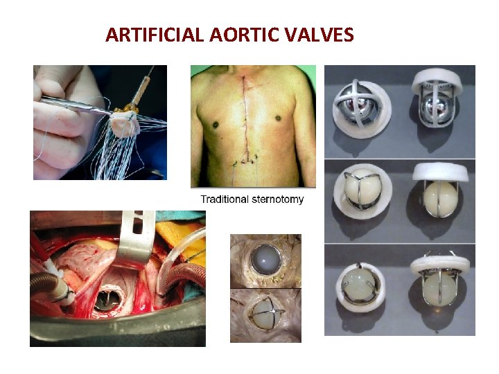 ARTIFICIAL AORTIC VALVES 