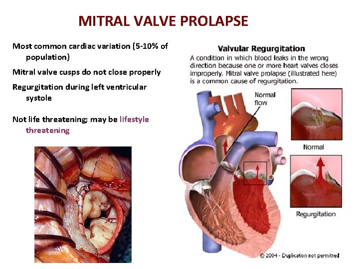 MITRAL VALVE PROLAPSE Most common cardiac variation (5 -10% of population) Mitral valve cusps