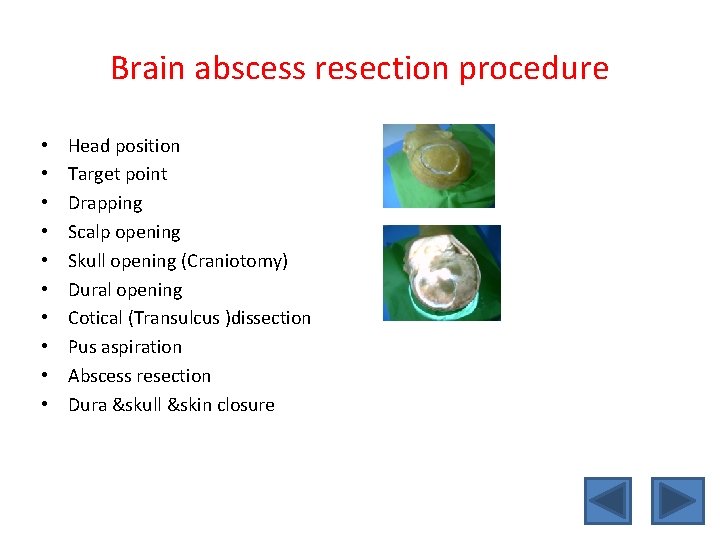 Brain abscess resection procedure • • • Head position Target point Drapping Scalp opening