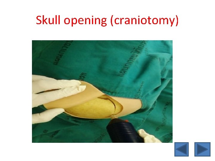 Skull opening (craniotomy) 