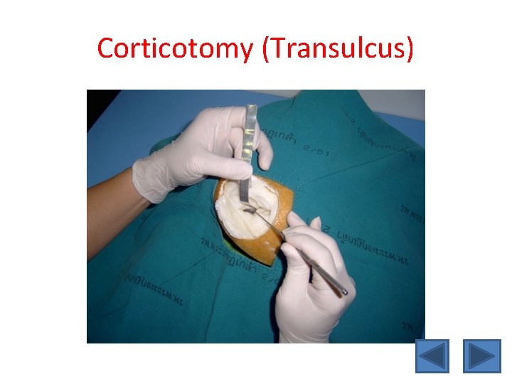 Corticotomy (Transulcus) 