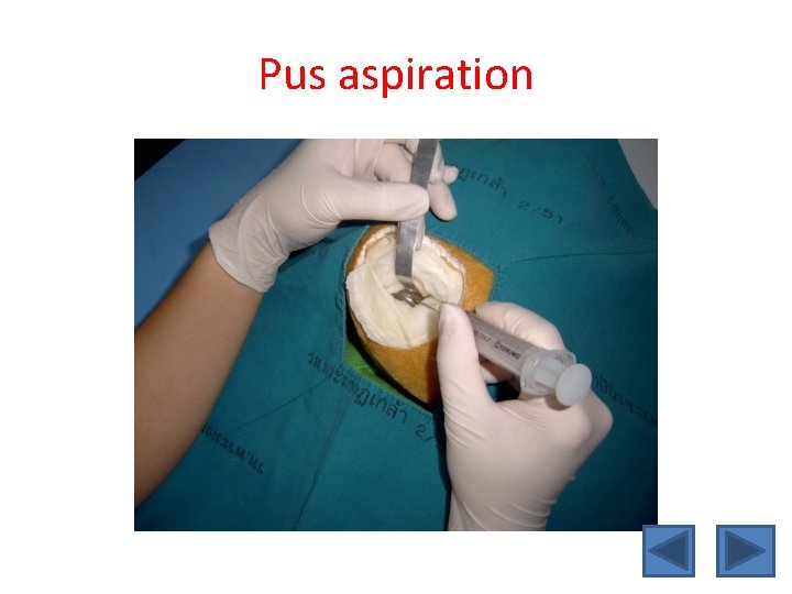 Pus aspiration 