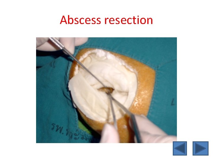 Abscess resection 