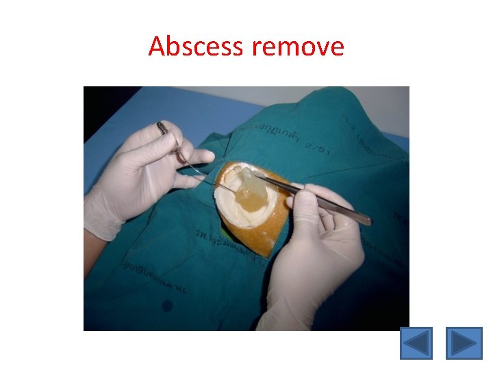 Abscess remove 