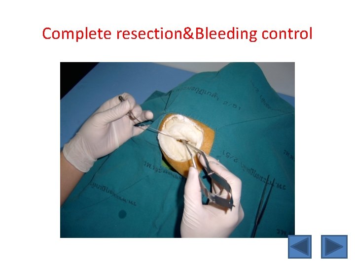 Complete resection&Bleeding control 