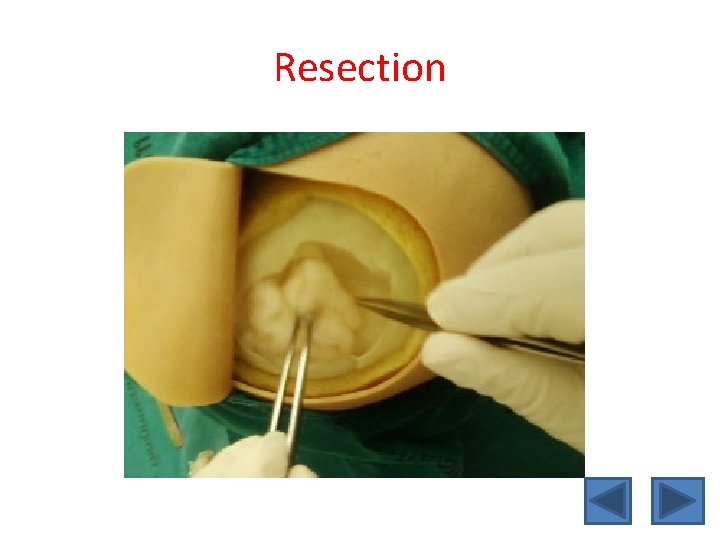 Resection 
