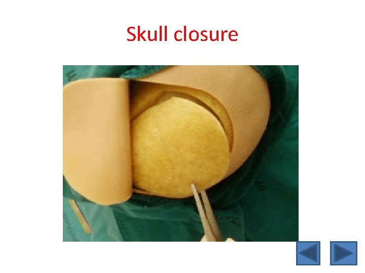 Skull closure 