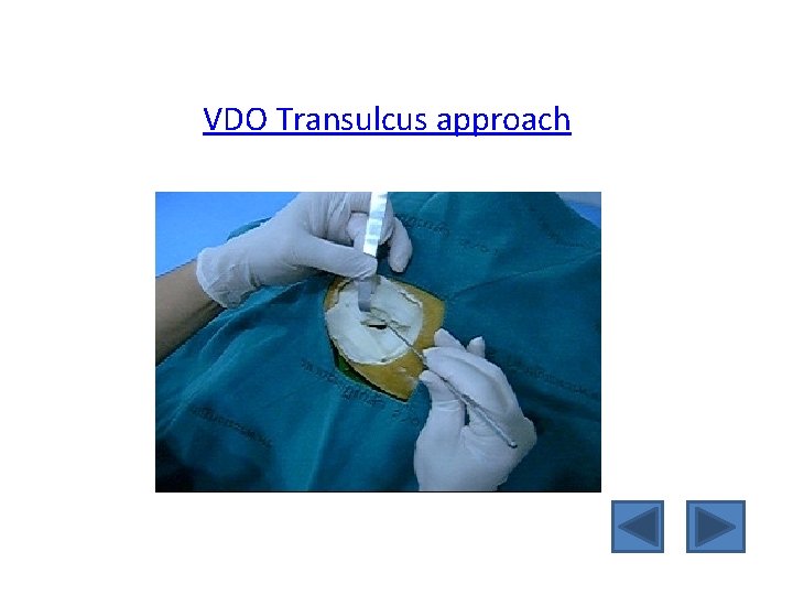 VDO Transulcus approach 