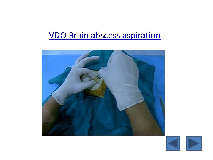 VDO Brain abscess aspiration 