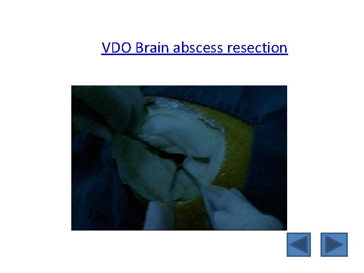 VDO Brain abscess resection 