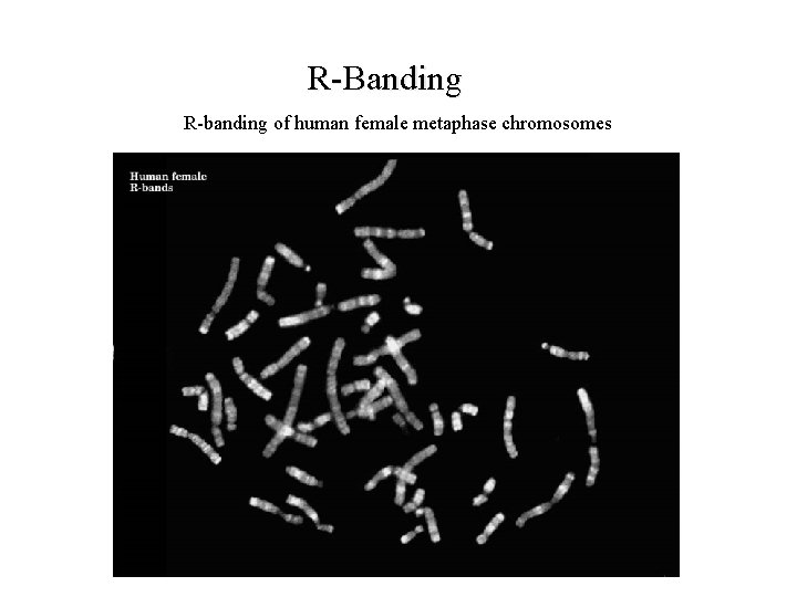 R Banding R banding of human female metaphase chromosomes 