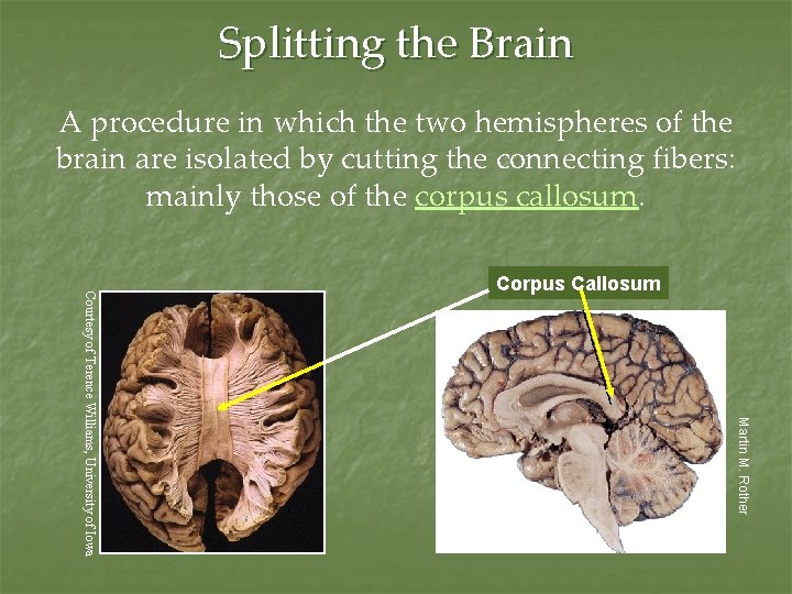 Splitting the Brain A procedure in which the two hemispheres of the brain are