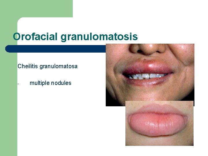 Orofacial granulomatosis Cheilitis granulomatosa - multiple nodules 
