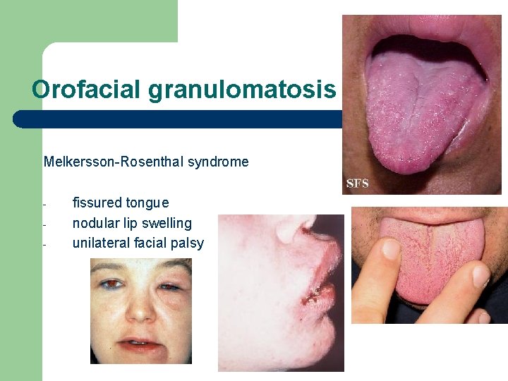 Orofacial granulomatosis Melkersson-Rosenthal syndrome - fissured tongue nodular lip swelling unilateral facial palsy 