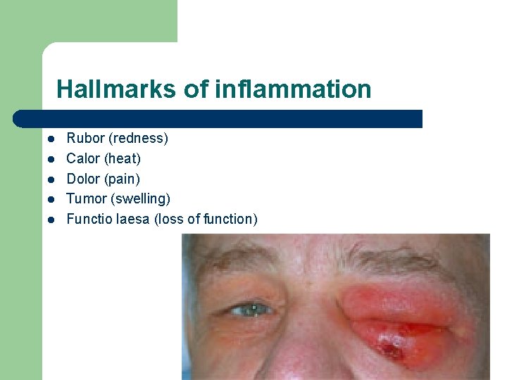 Hallmarks of inflammation l l l Rubor (redness) Calor (heat) Dolor (pain) Tumor (swelling)