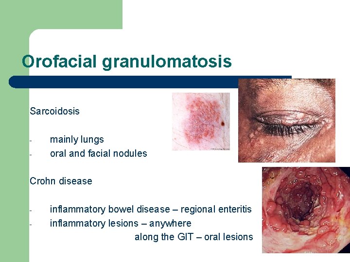 Orofacial granulomatosis Sarcoidosis - mainly lungs oral and facial nodules Crohn disease - inflammatory Orofacial granulomatosis Sarcoidosis - mainly lungs oral and facial nodules Crohn disease - inflammatory