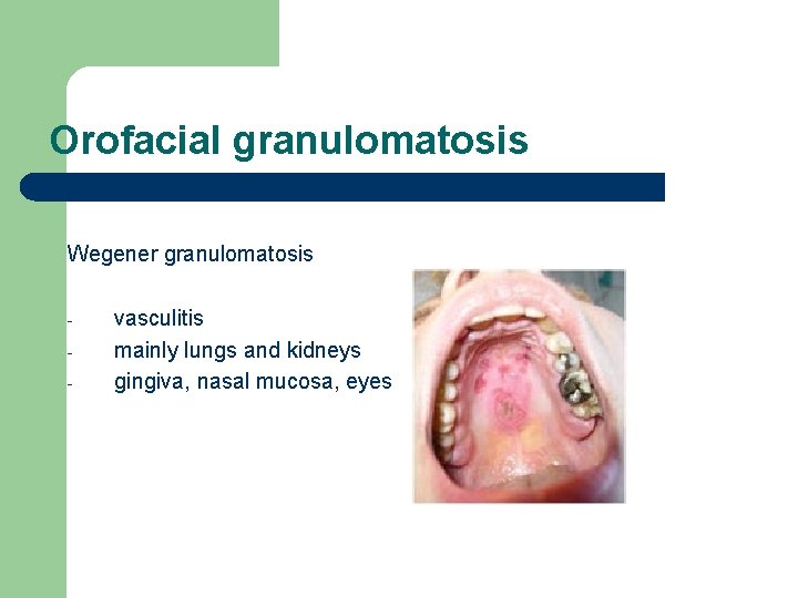 Orofacial granulomatosis Wegener granulomatosis - vasculitis mainly lungs and kidneys gingiva, nasal mucosa, eyes