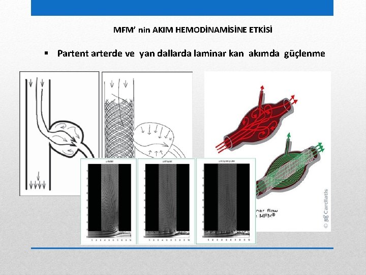 MFM’ nin AKIM HEMODİNAMİSİNE ETKİSİ § Partent arterde ve yan dallarda laminar kan akımda