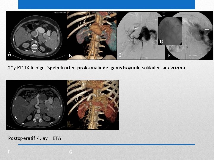 D A B C E 20 y KC TX’li olgu. Spelnik arter proksimalinde geniş