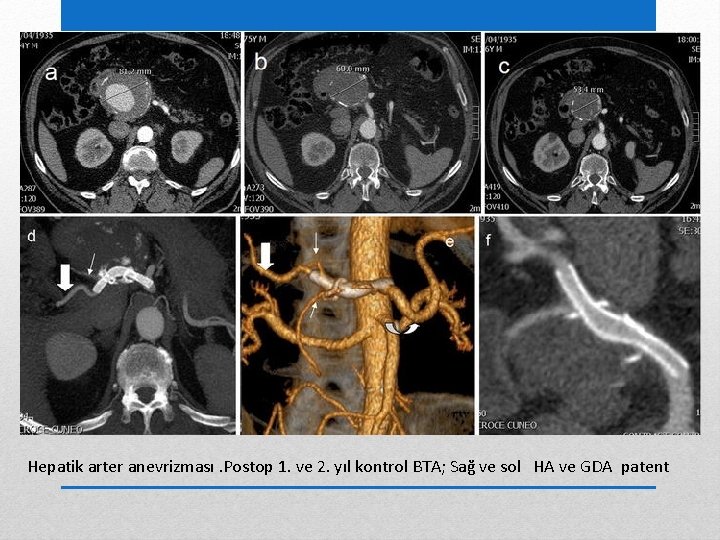 Hepatik arter anevrizması. Postop 1. ve 2. yıl kontrol BTA; Sağ ve sol HA