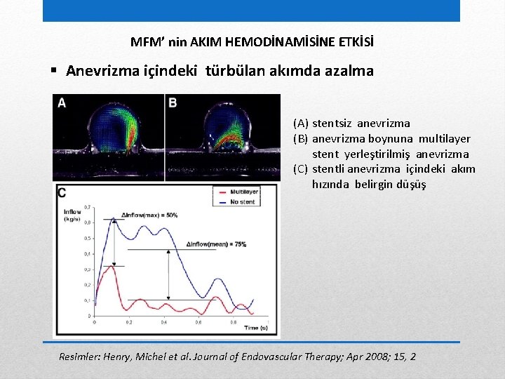 MFM’ nin AKIM HEMODİNAMİSİNE ETKİSİ § Anevrizma içindeki türbülan akımda azalma (A) stentsiz anevrizma