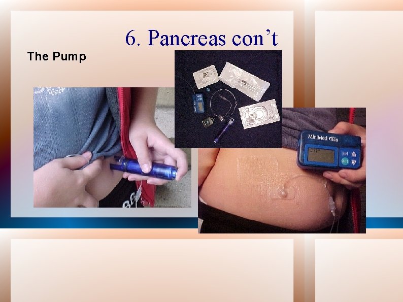The Pump 6. Pancreas con’t 