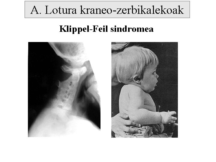A. Lotura kraneo-zerbikalekoak Klippel-Feil sindromea 