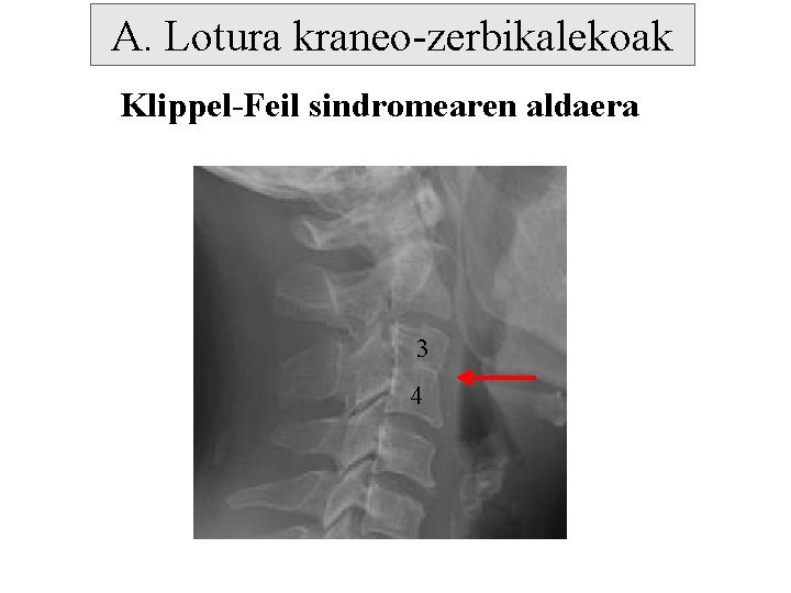 A. Lotura kraneo-zerbikalekoak Klippel-Feil sindromearen aldaera 3 4 