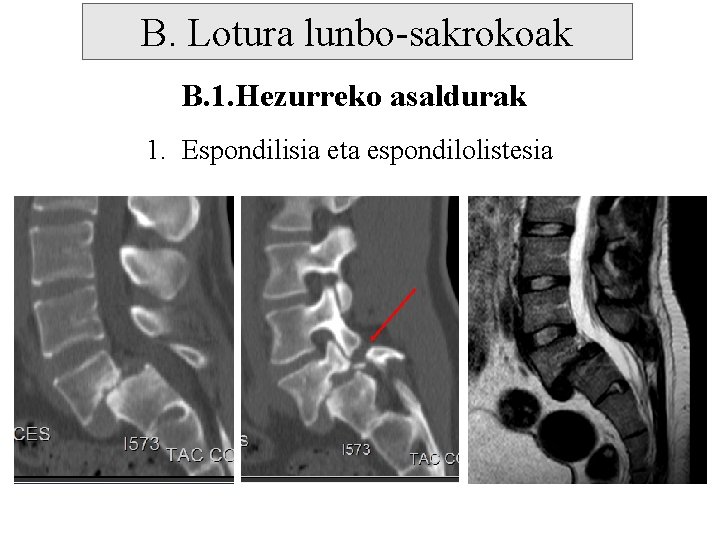 B. Lotura lunbo-sakrokoak B. 1. Hezurreko asaldurak 1. Espondilisia eta espondilolistesia 