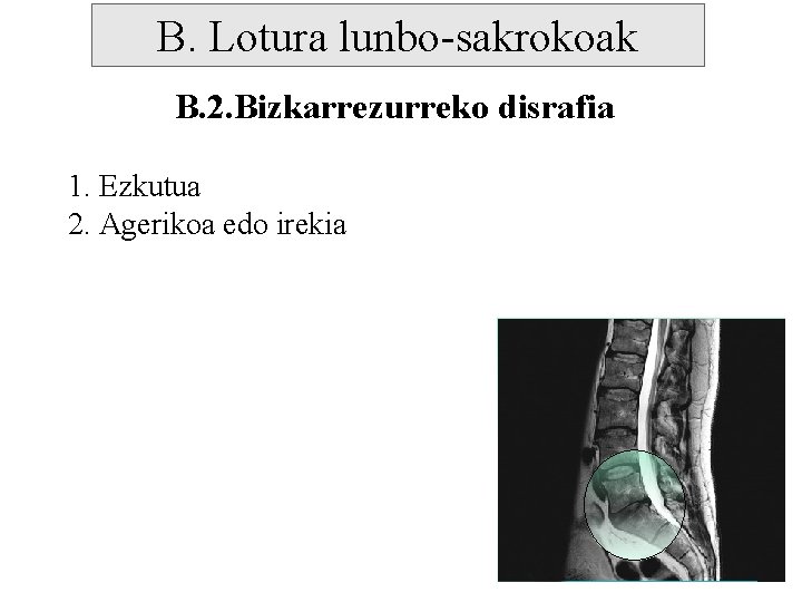 B. Lotura lunbo-sakrokoak B. 2. Bizkarrezurreko disrafia 1. Ezkutua 2. Agerikoa edo irekia 