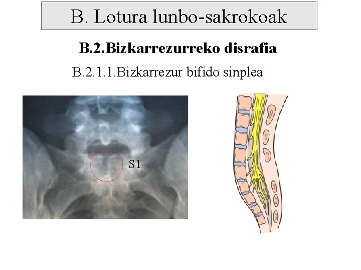 B. Lotura lunbo-sakrokoak B. 2. Bizkarrezurreko disrafia B. 2. 1. 1. Bizkarrezur bifido sinplea