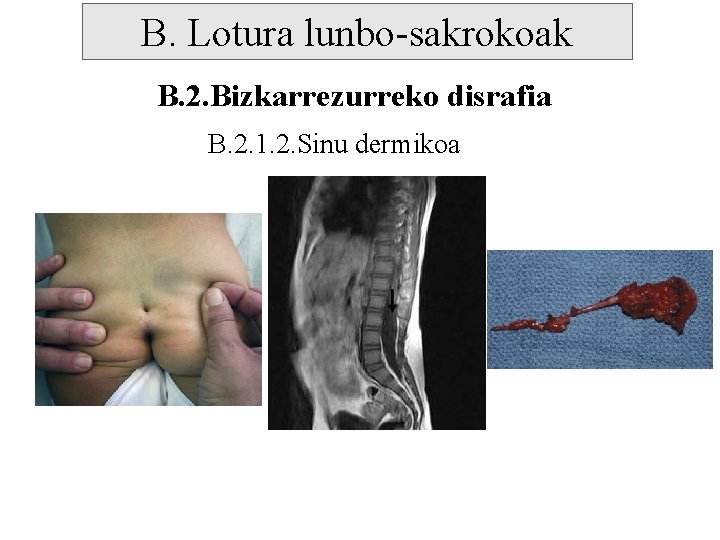 B. Lotura lunbo-sakrokoak B. 2. Bizkarrezurreko disrafia B. 2. 1. 2. Sinu dermikoa 