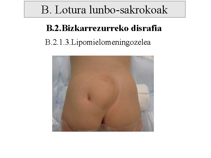 B. Lotura lunbo-sakrokoak B. 2. Bizkarrezurreko disrafia B. 2. 1. 3. Lipomielomeningozelea 
