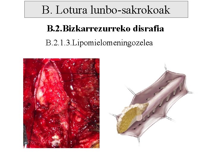 B. Lotura lunbo-sakrokoak B. 2. Bizkarrezurreko disrafia B. 2. 1. 3. Lipomielomeningozelea 