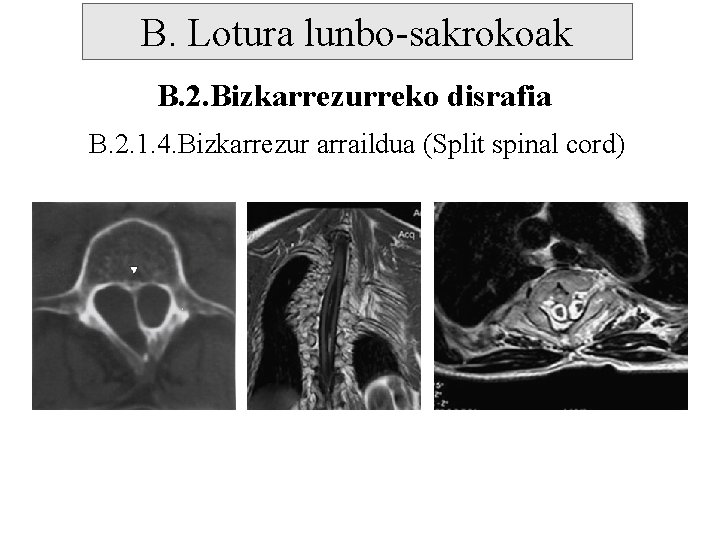 B. Lotura lunbo-sakrokoak B. 2. Bizkarrezurreko disrafia B. 2. 1. 4. Bizkarrezur arraildua (Split