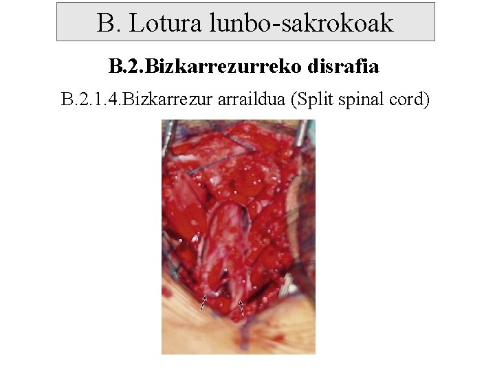 B. Lotura lunbo-sakrokoak B. 2. Bizkarrezurreko disrafia B. 2. 1. 4. Bizkarrezur arraildua (Split