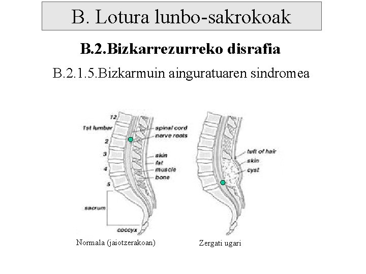 B. Lotura lunbo-sakrokoak B. 2. Bizkarrezurreko disrafia B. 2. 1. 5. Bizkarmuin ainguratuaren sindromea