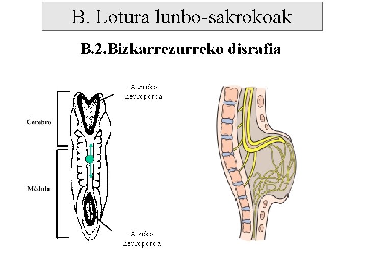 B. Lotura lunbo-sakrokoak B. 2. Bizkarrezurreko disrafia Aurreko neuroporoa Atzeko neuroporoa 