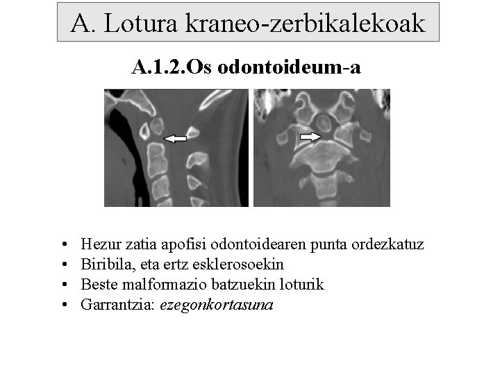 A. Lotura kraneo-zerbikalekoak A. 1. 2. Os odontoideum-a • • Hezur zatia apofisi odontoidearen